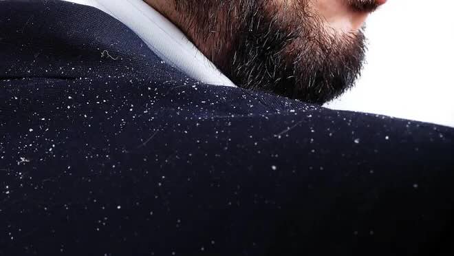 How to Hide Dandruff: Quick Fixes and Long-Term Solutions